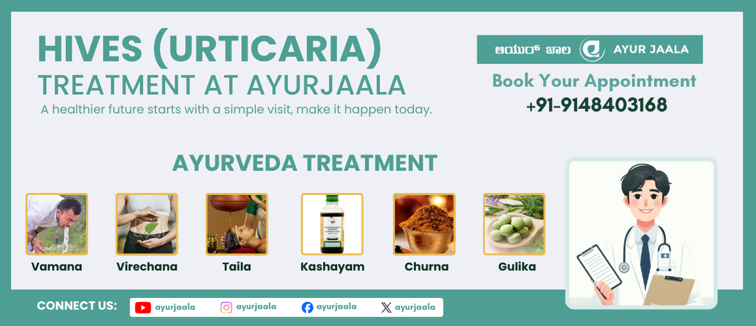 Welts and Worries? Find Relief from Hives with Ayurveda (Urticaria)